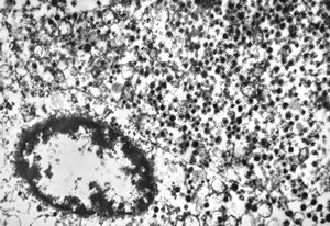 F,79y. | paraganglioma - ileum